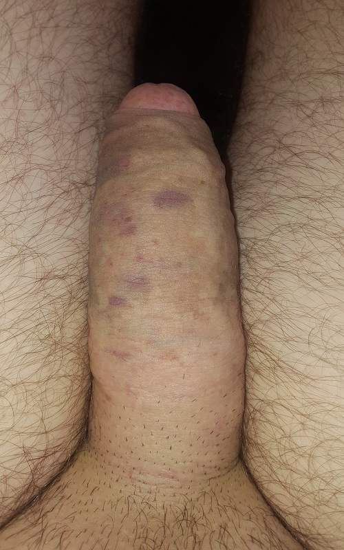 Patient I five hours after 14 ml filler procedure, minor bruising apparent