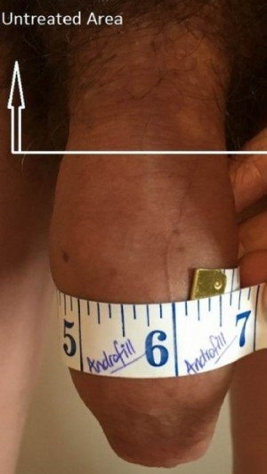 Patient J after penis enlargement injections, early stage with swelling