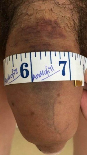 Patient J result after one session, 8 ml, length part filled
