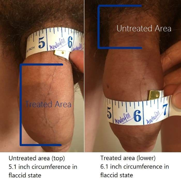 Patient J before and after 8 ml Androfill, lower two-thirds of shaft treated