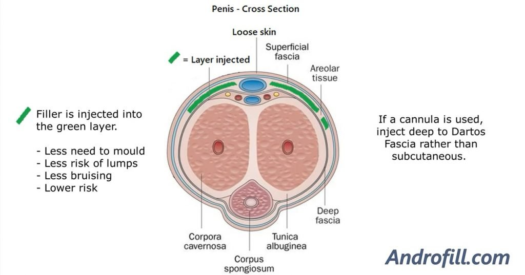 Penis cross-section diagram showing the layer injected with the Androfill technique, deep to the Dartos fascia rather than subcutaneous